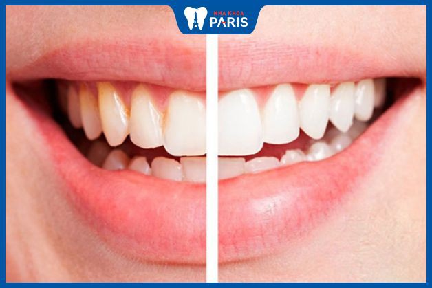 Kem đánh răng có công dụng làm trắng nhưng hiệu quả chậm