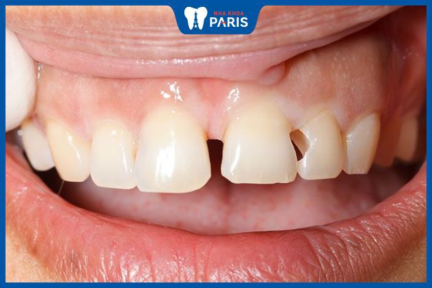 Răng cửa bị mẻ lớn không thể hàn răng