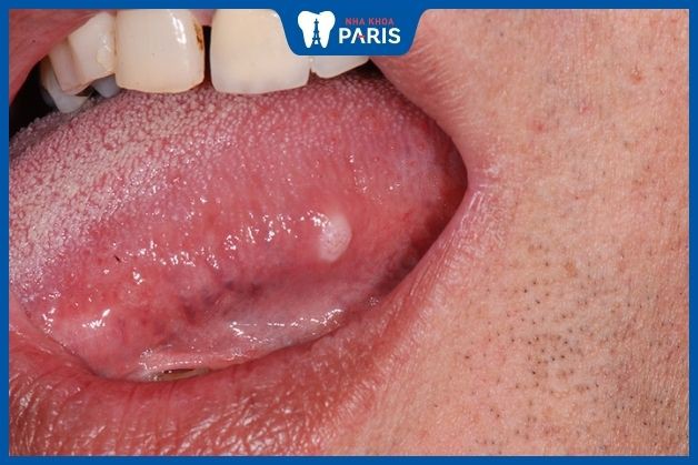 Khối u ở lưỡi xuất hiện trong thời gian dài