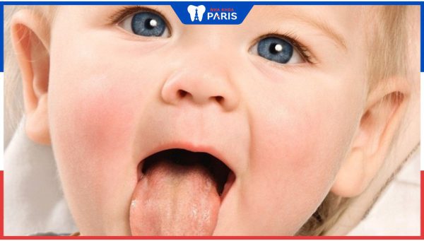 Dấu hiệu cho biết lưỡi trẻ sơ sinh bình thường cha mẹ cần biết