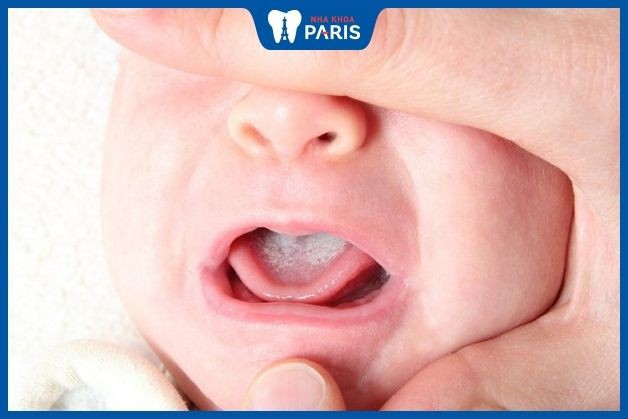 Lưỡi trẻ sơ sinh có màu trắng