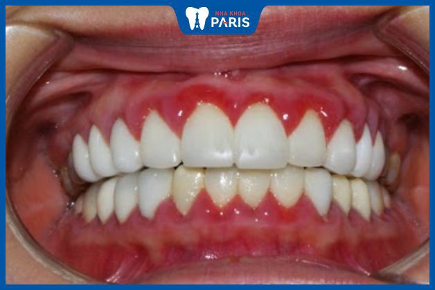 Nguyên nhân xuất hiện các biến chứng bọc răng sứ