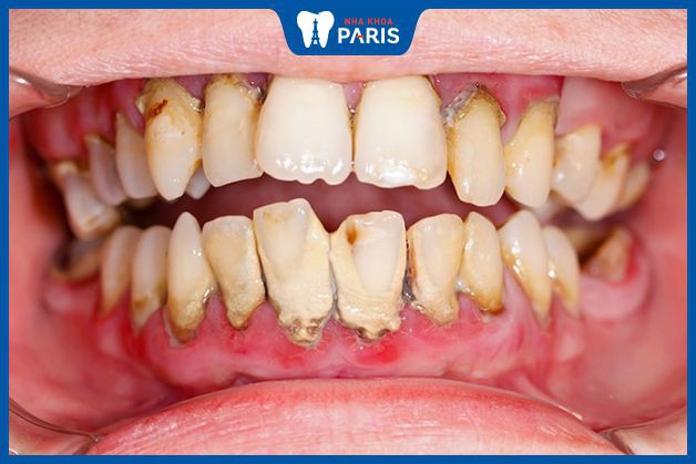 Viêm nha chu là một dạng của nhiễm khuẩn răng miệng