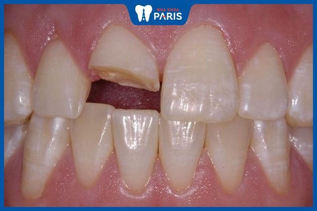 Gãy răng khiến vi khuẩn dễ xâm nhập vào sâu bên trong