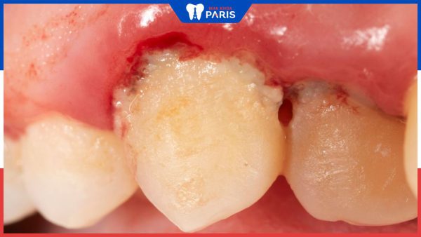 Nhiễm khuẩn răng miệng: Nguyên nhân gây bệnh và thuốc điều trị