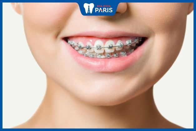 Niềng răng giúp tăng thẩm mỹ, răng cân đối thẳng đều