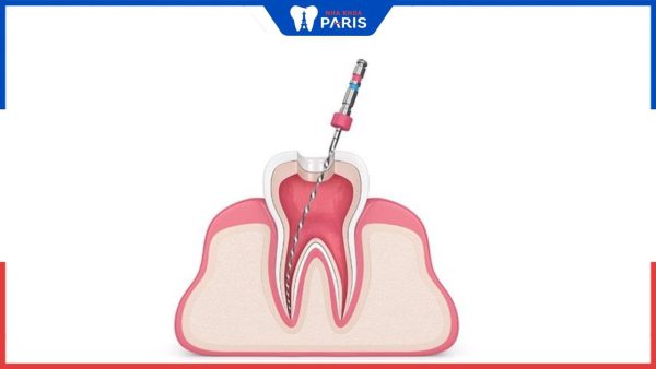 Điều trị tủy răng là gì? Quy trình điều trị tủy răng chi tiết