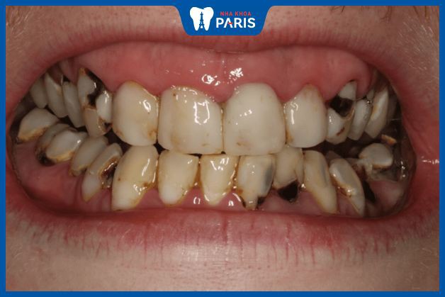 Răng bị ê buốt khi uống nước do bệnh lý sâu răng