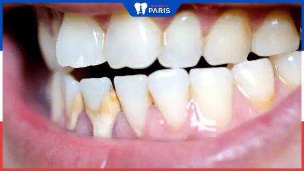 Răng có mảng bám ố vàng: Nguyên nhân và cách khắc phục