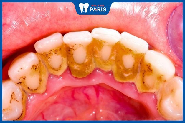 Răng bị ố vàng gây ra các vấn đề sức khỏe răng miệng