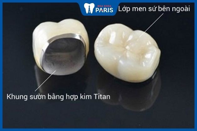 Răng sứ hợp kim Titan có cấu tạo 2 phần