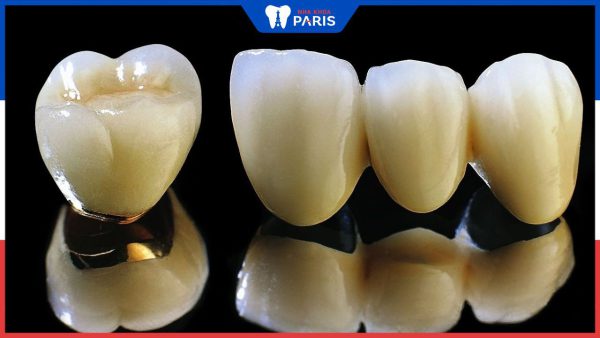 Răng sứ hợp kim Titan – Sự lựa chọn đáng tin cậy cho nụ cười đẹp
