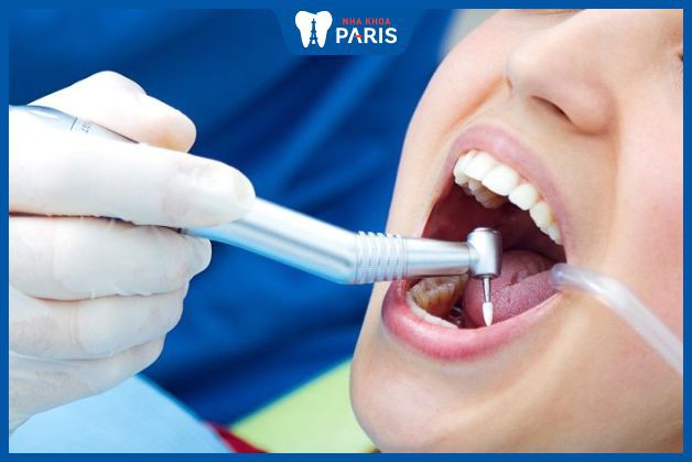 Dịch vụ bọc răng sứ tại Nha khoa Paris