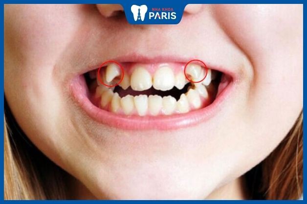 Răng mọc sai thứ tự có thể khiến răng vĩnh viễn mọc sai lệch