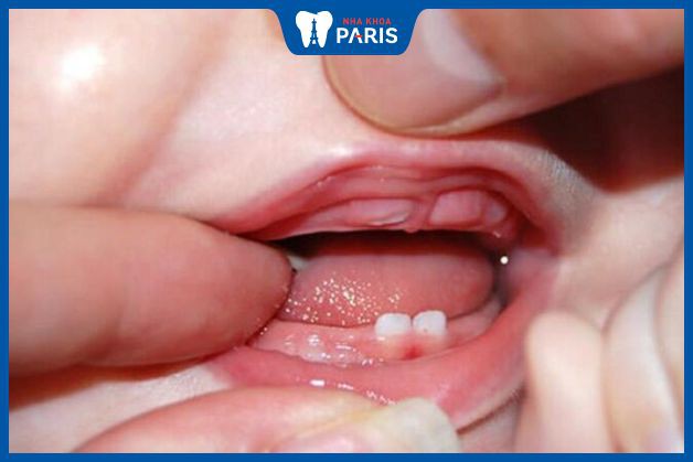 Trẻ thường mọc răng khi được 6 tháng tuổi