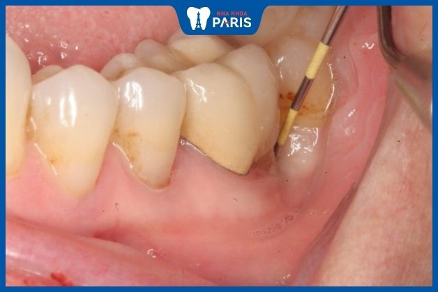Bệnh trở nặng khiến ngà răng đổi màu
