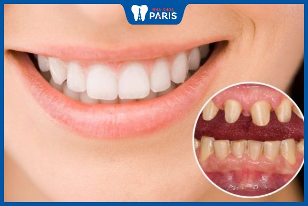Phương pháp bọc răng sứ có tính thẩm mỹ cao
