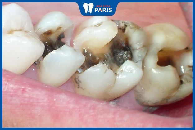 Sâu răng - Các bệnh răng miệng người già thường gặp