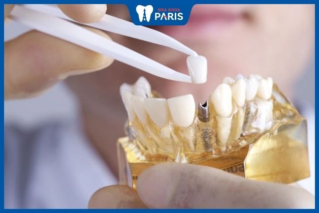 Cách khắc phục răng Implant bị rơi