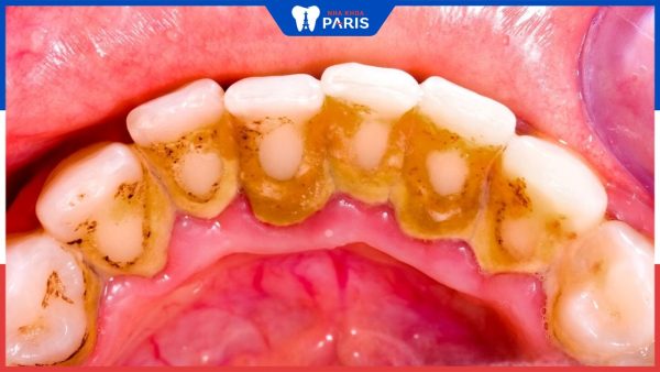 Tác hại cao răng khổng lồ và Phương pháp loại bỏ