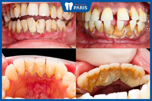 Cao răng nặng ảnh hưởng đến thẩm mỹ