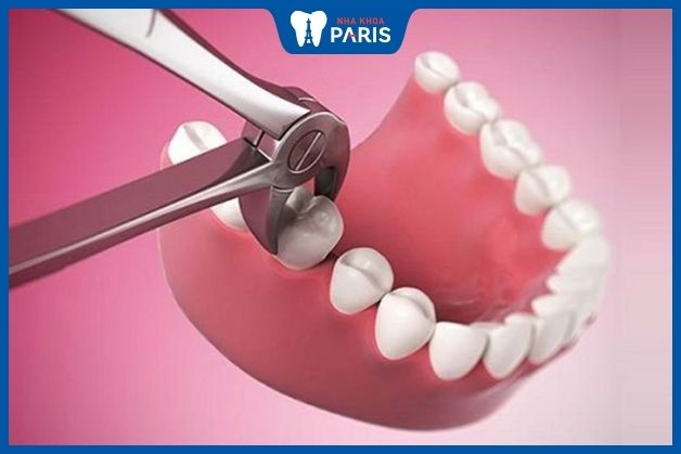 Không nên nhổ răng số 6 nếu răng vẫn có thể điều trị