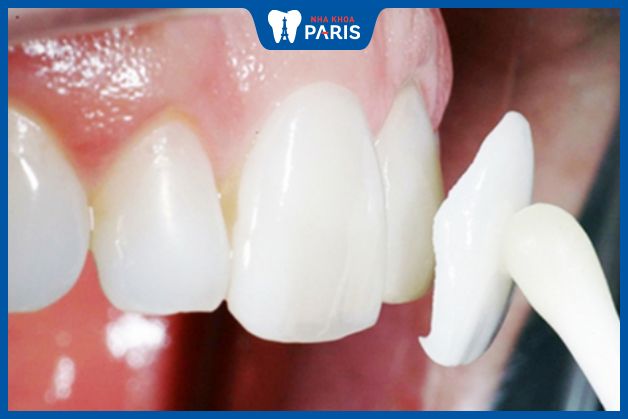 Phương pháp dán sứ giúp hạn chế tình trạng mòn men răng