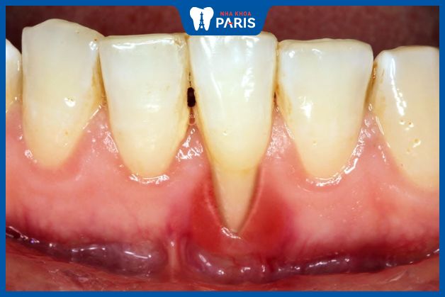 Tụt lợi chân răng - dấu hiệu bị viêm nướu răng ở người lớn