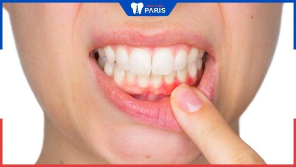 7 Dấu hiệu bị viêm nướu răng ở người lớn và cách điều trị