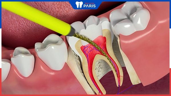5 Dấu hiệu điều trị tủy răng thất bại và cách khắc phục