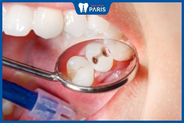 Dễ mắc các bệnh lý về răng miệng