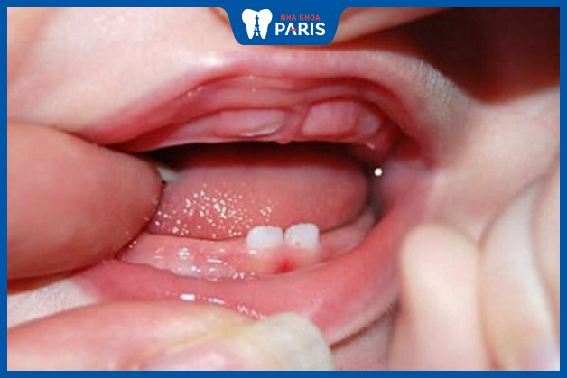 Nướu hàm trên bị sưng khi trẻ chuẩn bị mọc răng