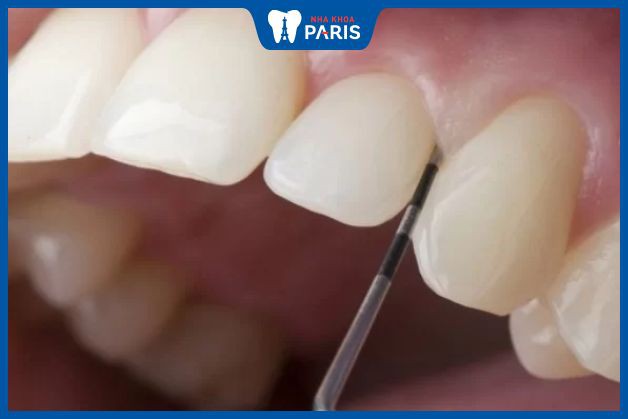 Mài răng trước bọc sứ để điều chỉnh hình thể của răng