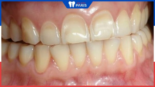 Nguyên nhân gây mòn men răng và cách điều trị hiệu quả