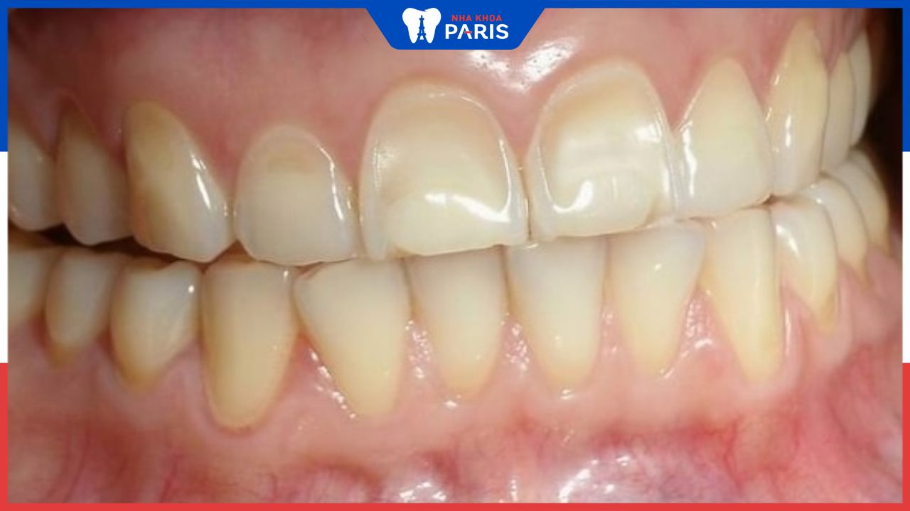 Nguyên nhân gây mòn men răng và cách điều trị hiệu quả
