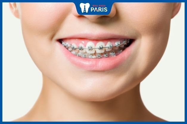 Niềng răng là phương pháp cải thiện gương mặt mất cân đối do cấu trúc hàm
