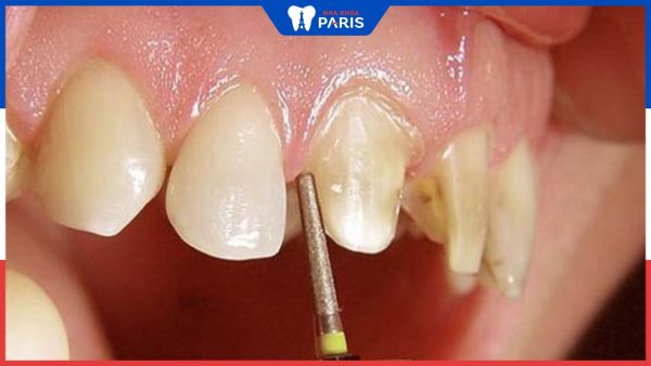 Răng bọc sứ bị viêm tủy do đâu? Cách khắc phục hiệu quả