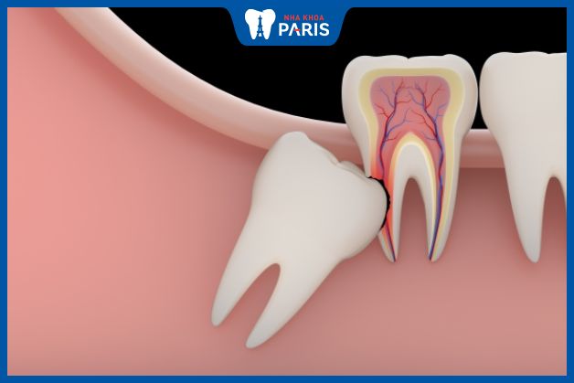 Răng khôn bị mọc ngầm do cung hàm không còn đủ khoảng trống