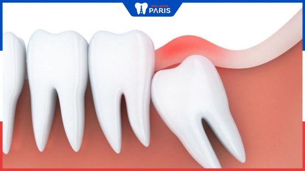 Răng khôn mọc ngầm gây ra những rủi ro gì? Có nên nhổ không?