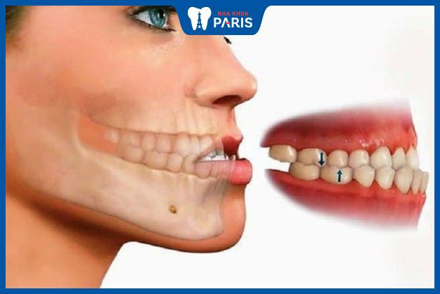 Móm răng do xương hàm dưới phát triển quá nhanh