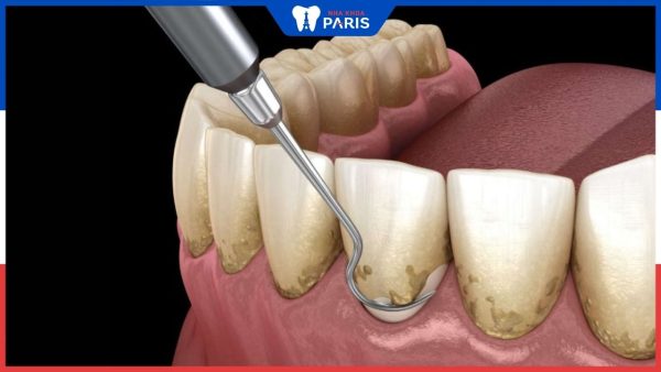 Răng sứ có phải cạo vôi răng không – Bác sĩ nha khoa giải đáp