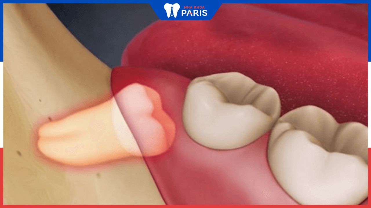 Sưng nướu răng khôn: Triệu chứng và cách giảm đau hiệu quả