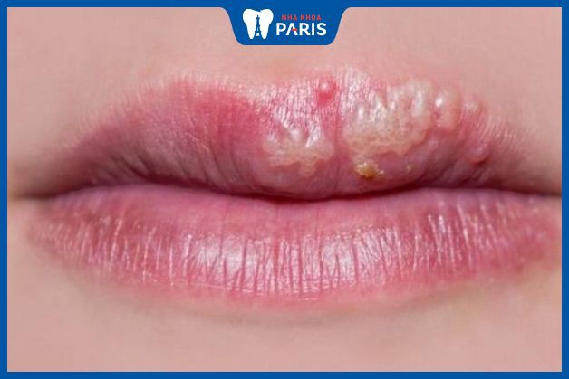 Hiện chưa có thuốc điều trị triệt để bệnh Herpes môi