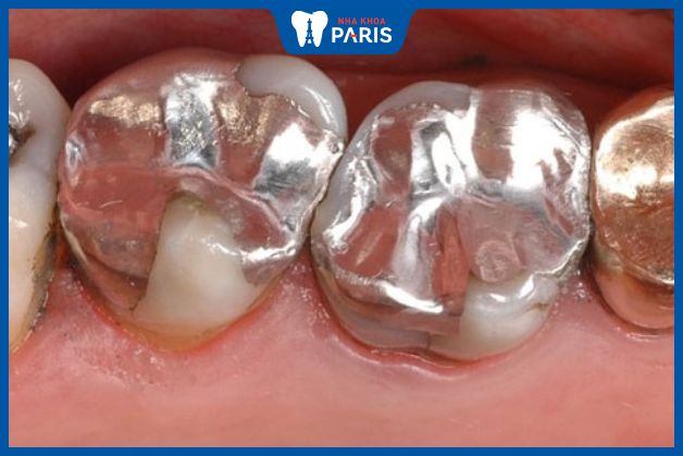 Trám răng giúp tái tạo lại phần men răng