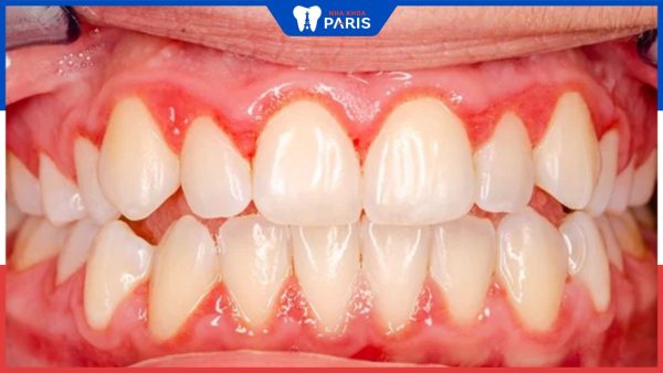 Viêm chân răng giả nguyên nhân do đâu? Cách điều trị thế nào