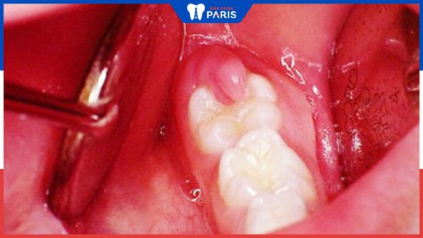 Viêm lợi răng trong cùng: Nguyên nhân và cách điều trị