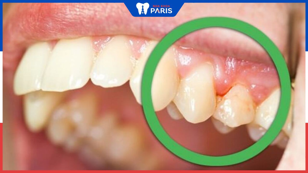Viêm quanh cuống răng: Chẩn đoán nhanh, điều trị sớm