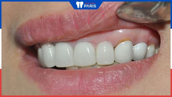 Nguyên nhân bọc răng sứ bị tụt lợi và cách khắc phục