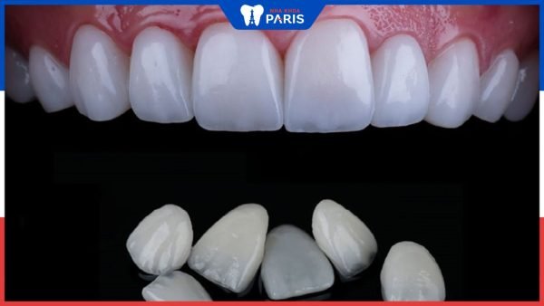 Bọc răng sứ có làm thay đổi gương mặt không? Bác sĩ nha khoa tư vấn