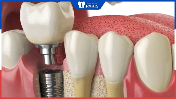 Cấy trụ Implant bao lâu thì gắn răng – 5 yếu tố ảnh hưởng
